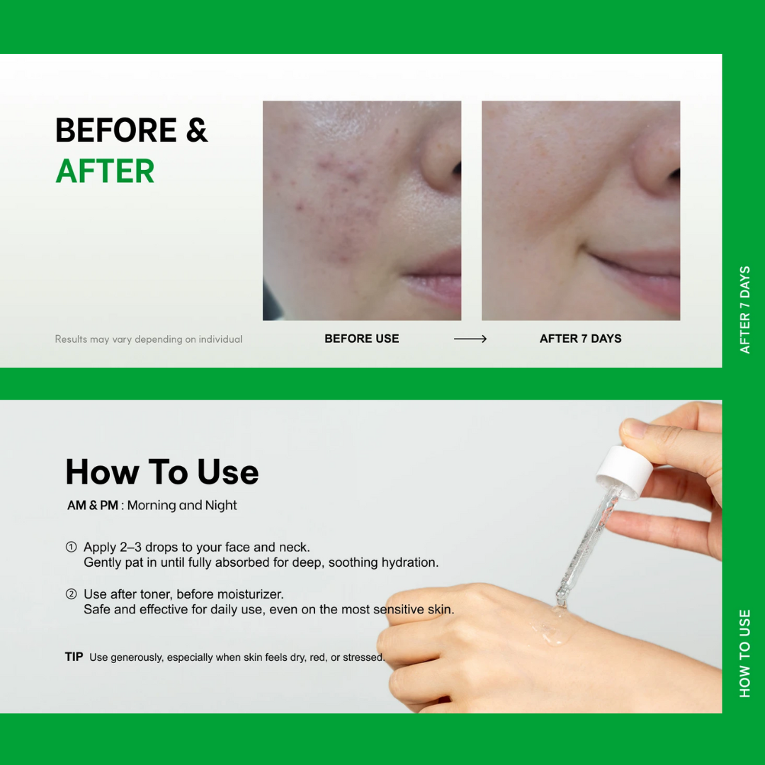 Centelsome 5X Soothing Serum 50ml Anti-Aging Acne Treatment